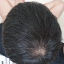 2539 | 먹는 탈모약 7년 3개월 복용 후기 (ft. 챗지피티)