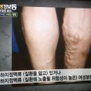 압박스타킹의 부작용 이미지