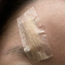 함희정하태원성형외과의원 | 내돈내산 함희정 성형외과에서 흉터 수술 받은 후기‼️ 3년 지난 현재 후기까지~~