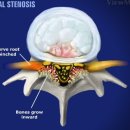 Spinal stenosis 이미지