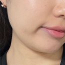 중로2-600 | 대전 둔산동 피부과 리프팅 추천! 올타이트리프팅 600샷 내돈내산 후기
