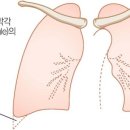 늑막염 이미지