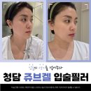 더쥬브 | [청담] [쥬브겔후기] 입술에 생기를 찾고 싶다면 청담 쥬브겔 입술필러 맞아라!