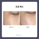 벨포인트의원 네이버블로그