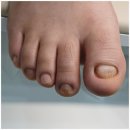 서울메디칼 | 부모님 발톱무좀 치료 고민중이시라면 서울늘봄메디칼의원 추천드려요 ~!!