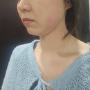 부자안경 | W14. 이중턱 부자의 울쎄라 300샷 후기