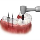 e-편한치과기공소 | 기존 임플란트를 최대한 살리는 기흥구치과