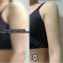 르로제의원 | 상체지방흡입 팔뚝살빼기 전후 후기 체형 디자인