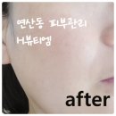 디.엠뷰티 | 연산동피부샵 H뷰티엠 콜드플라즈마 비타민샤워 피부관리후기 탄력 잡티 관리에 효과봤어요