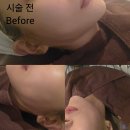 청량리톡스앤필의원 | 입술필러,인모드 내돈내산 찐후기_톡스앤필목동점