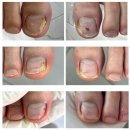 한솔종합중기 | 전주문제성발톱, 낫고 싶다면? 레푸스만의 1:1맞춤 가이드대로 하세요!