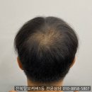 익산여성의전화 | 익산두피문신 잘하는곳 가격 효과 후기 한방정리