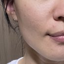 김한의원 | 신논현한의원 • 새살침 2회차 솔직 후기 (여드름 흉터 치료 효과)