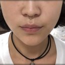 강남예일미의원 | 강남역미의원 슈링크리프팅 대박후기