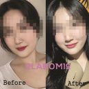 라보미의원 | (시술후기) 아름다운 미소를 담은 입술필러 후기 _ 라보미의원 전주입술필러 추천병원