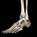 울산연세병원 | 1mm의 오차가 만드는 40%의 차이: 복숭아뼈(외복사) 및 제5중족골 골절 수술 기록 -울산연세병원/정형외과