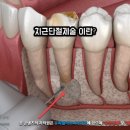 아미치과기공소 | 앞니 크라운 통증 재신경치료, 치근단절제술 복구이야기