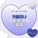 김종 | 카일리나 시술부터 2년사용 그리고 제거까지의 후기! 비용 공유 장점 단점