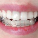 서울더좋은치과의원 | 서울 강남 논현 아름드리 치과의원 10개월의 부분 치아 교정 후기 내돈내산