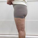 하체 | 허벅지지방흡입후기, 하체지방흡입하고 가장 만족했던 변화