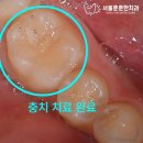 이레치과의원 | 광진구 소아 충치, 실란트 보험으로 치료 조건 대상 방법 후기