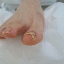레푸스 평촌점 | 몇년간의 고민을 해결한 안양내성발톱, 레푸스 평촌점 후기