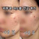 피부과 여드름 연고 제품 후기 | 디크네 크림, 닥터에스떼 EGF 스팟 리커버리 사용기