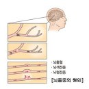 뇌졸중 이미지