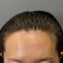 국제SMP두미각대한내미연속눈썹협회 | 범계 온필SMP 전문 두피반영구 헤어라인 후기