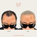 TMW 탈모왕수원 네이버블로그