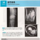 골연골종증(osteochondromatosis) . 이미지