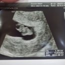 임신 초기부터 출산까지. 송파고은빛산부인과 선택제왕절개 후기 (오소영원장님)