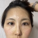 [나의 아토피관리]민감성 안면 지루성 피부염_리쥬란3회(4cc)+브이빔레이저5회_실제 효과 본 후기 및 경과