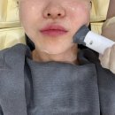 (주)영레이저 | [세르프 리프팅] 통증적은 리프팅 세르프600샷 받고 온 동대문피부과 시술후기🔥