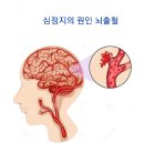 영화배우 강수연을 무너뜨린 ‘뇌출혈&#39;, &#39;심정지의 원인&#39; 뇌출혈은 왜 오는가 ? 이미지