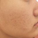 (주)와이비랩 서울지사 | 콜드 플라즈마로 환한 피부를 되찾은 은평구 피부관리 &lt;이지뷰티랩&gt; 후기!