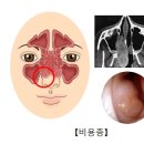 비용종 Nasal polyp 귀코목질환 이미지