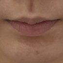 프렌즈의원 | 홍대 프로젝트유에서 입술필러 받고 안젤리나졸리 된 후기