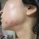 선명한의원 | 강남여드름한의원 여드름 모공흉터 새살침 + 시크릿레이저 3회차