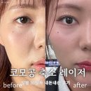 대보의료기계서비스 | 강남 양재피부과 코모공 축소시술 실펌 레이저 10일차 효과 후기(나비존)