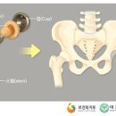 인공관절치환수술 대상질환 분류표[별표124][6대인공관절치환수술(연간1회한)보장 특별약관] 이미지