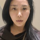 포르테의원 | 안면거상급 효과 태전동피부과 엘라스티실리프팅(포르테더블)비용 효과