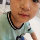 이앤장피부과의원 | 창원 물사마귀 8살 흉터, 번짐, 이앤장피부과