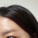 정감한의원 | 신촌 편평사마귀 한의원 침제거 얼굴 통증 후기 내돈내산