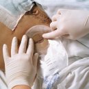wound bag 배액관 평가 가능여부 문의드립니다. 이미지