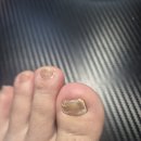 100년재생의원 | 평택무좀 내성발톱| 5년 넘게 계속 방치했던 무좀치료/ 푸스케어 평택고덕점