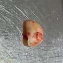 [천안 리건치과] 매복 사랑니 발치 후기