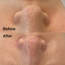 리더스프라자 앞 | 알엔스킨뷰티랩 익셉션필링, 블랙헤드 및 에르모듀 재생관리 후기