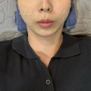 아우라지장 | 연신내 은평우태하피부과 스킨아우라 GWAVE핸들링 스킨보톡스 후기