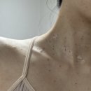 분당 편평사마귀 성지 한의원 추천 제거 후 관리 내돈내산